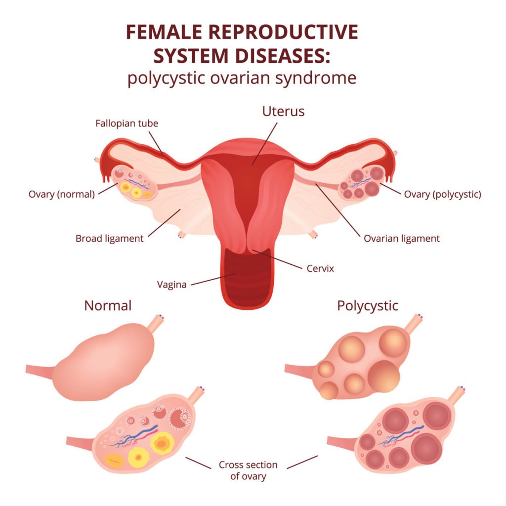 polycystic-ovary-syndrome